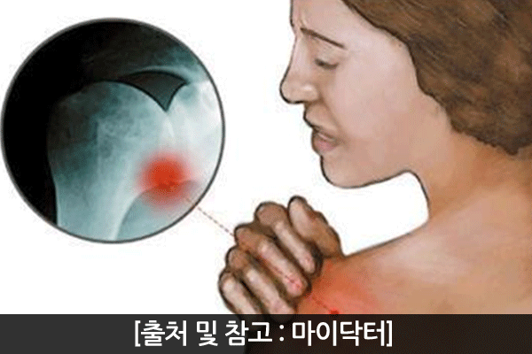 오십견이미지
